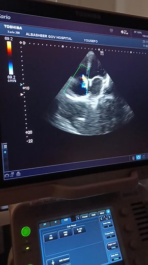 29K views · 242 reactions | What is the diastolic dysfunction grading for this 68 year's Old patient | Dr. Fakhri Ibrahim Echocardiography from the beginning to professionalism | Facebook