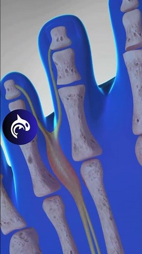 See what Morton's Neuroma of the Foot looks like in a 4K 3D animation.