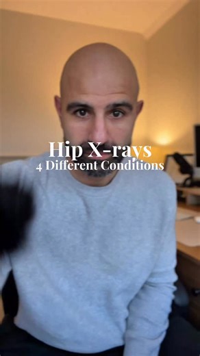 Mehmet Gem | Specialist Hip Physio on Instagram: "1️⃣ CAM impingement (FAI) • Excess bone at the femoral head neck junction Alpha angle typically greater than 55–60 degrees Reduced head neck offset • Increases shear stress on the labrum and cartilage during flexion and rotation 2️⃣ Pincer impingement (FAI) • Excess acetabular coverage of the femoral head • Lateral centre edge angle often greater than 40 degrees • Crossover or posterior wall signs may be present • Labral compression is the domina