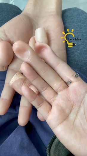 25K views · 32 reactions | Silicone finger prosthesis | Home Idea | Facebook