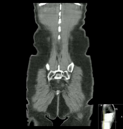 Dedifferentiated liposarcoma mimicking a primary colon mass - CT scan