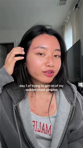 im giving myself a week to get rid of my chest pimples 😭 #acneproneskin #acneskincare #bodyacne #pimples