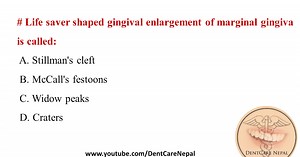 Life saver shaped gingival enlargement of Marginal Gingiva