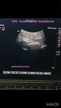 Ultrasound Guided Spinal Anaesthesia #pocus #regional