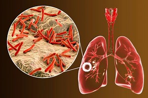 Pulmonary tuberculosis: medical and nursing management