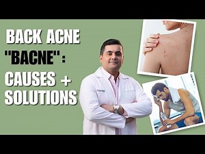 Back Acne: Causes + Solutions. 🧑🏻‍⚕️