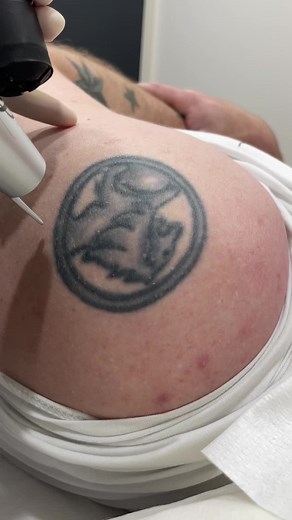 Lasertat Tattoo Removal on TikTok