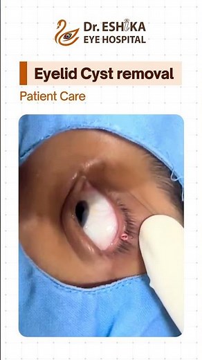 👁️ Eyelid Cyst Treatment