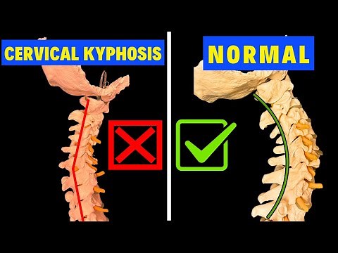 Cervical Kyphosis FIXED, Case Study with Before & After Xrays, Dr. Walter Salubro