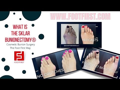The Sklar Bunionectomy | Bunion Surgery the Foot First Way