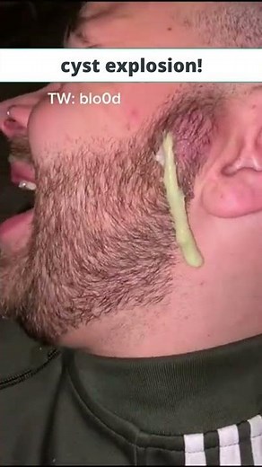 cyst explosion