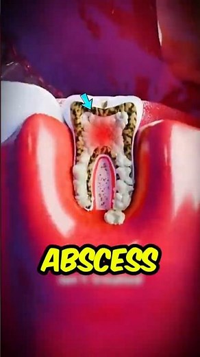 Your Teeth Are Rotting From The Inside Right Now 🦷 #ToothDecay