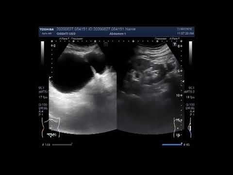 Ultrasound Video showing two cases, Diverticulum of the urinary bladder and Prostatic Utricle Cyst.