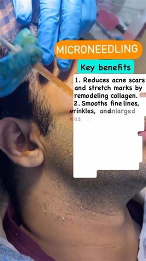 Microneedling for scar treatment | skin rejuvenation | Dr. Ismat Ara Khan