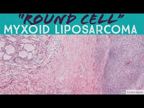 "Round cell" High Grade Myxoid Liposarcoma
