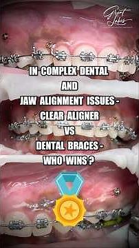 "DENTAL BRACES VS ALIGNERS - WHO WINS?" - #braces #dentalbraces #invisalign #aligners #clearaligner