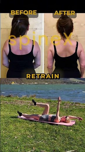 How to train after Spinal fusion