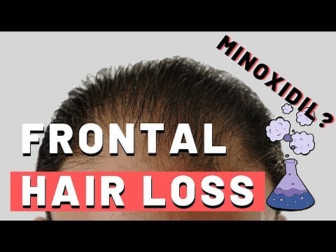 Frontal Hair Loss - Does Minoxidil Work?
