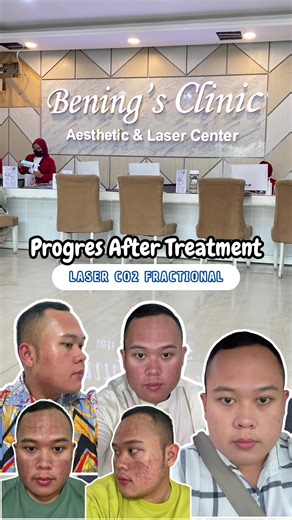Progres After Laser CO2 Fractional butuh waktu 13hari di wajah gue buat recovery dan kelihatan hasilnya 💯 treatment di @Bening's Clinic Lampung #laserco2 #co2fractional_laser #co2laser #bopeng #atasibopengwajah #foryou