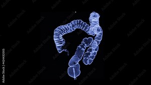 CT colonography 3D rendering turn around on the screen for screening colorectal cancer. Check up Screening cancer of colon.