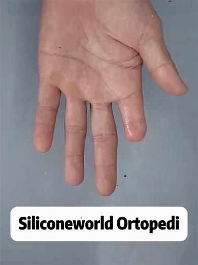 Silicone Hand Prosthesis for Improved Daily Living