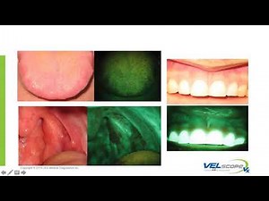 VELscope Training Webinar