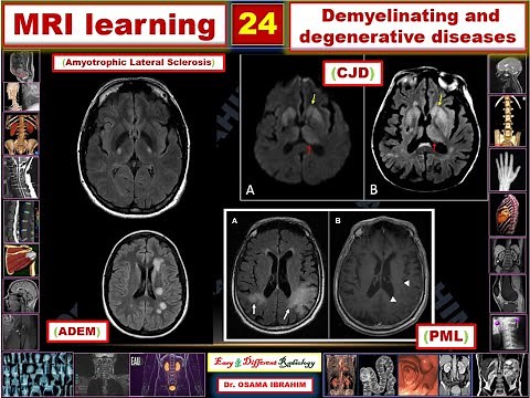 MRI learning 24 Demyelination and degenerative diseases