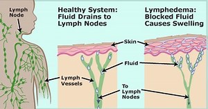 7 Easy Ways To Quickly Unclog Your Lymph Nodes To Reduce Swelling And Flush Out Toxins