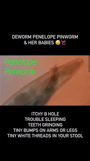 Did you know worms can cause itching under the skin ? Did you know worms can cause your booty hole to itch🪱 It’s not an itch you can scratch . You have to detox and kill them for this itch to stop. I’m not joking, y’all. They’re called pinworms, a type of parasite. Society has conditioned us to think parasites are a 3rd world country thing, but truth be told, they are not! You have them , your kids have them and so do your PETS ! According to US pharmacist, it’s estimated that pinworms affect 4