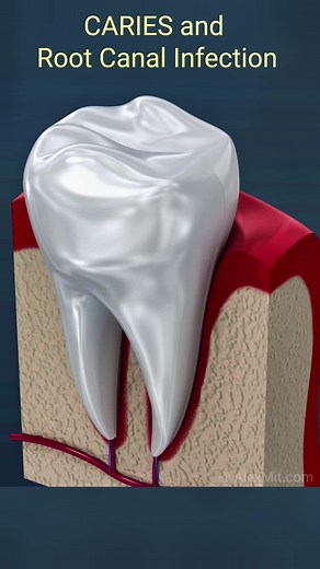 Dental caries and root canal infection. #dental #caries #tooth #teeth #dentist #cavity #hygiene #dentalhygienist #dentalhygiene
