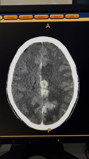 Multiple Ring Enhancing Lesions CT Brain | Intracranial Tuberculomas #shorts