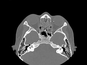Acute sinusitis
