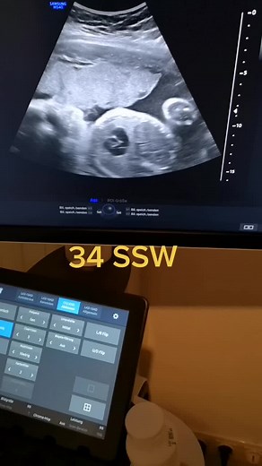 In welcher SSW seit ihr? #34ssw #schwangerschaft #mamatobe #ultraschall #herzschlag #baby