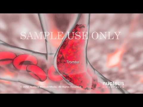 Accidente cerebrovascular isquémico