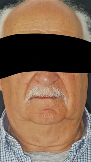 #ImplantCaseShowcase#DentalImplantVisuals#PrecisionImplants#ImplantTreatment#VisualImplantMarketing