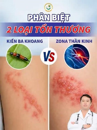 Rove beetle dermatitis or shingles? How to tell them apart quickly ⚠️