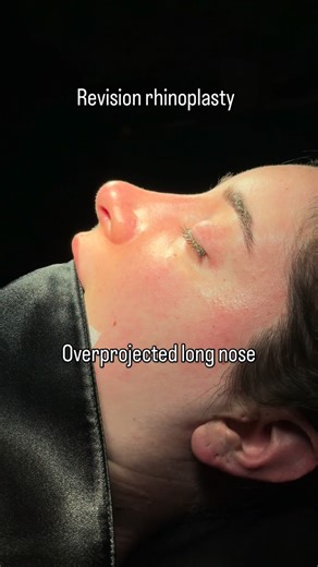 Nazlı Selvi on Instagram: "Revision rhinoplasty with rib cartilage🙌 #nasenkorrektur #rhinoplasty #revisionrhinoplasty"