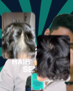 1.3M views · 175K reactions | Struggling with bald patches? Hear firsthand how Pilgrim's Advanced Hair Growth Serum transformed his life!  ✨ Infused with Redensyl and Anagain, this powerful serum promotes hair growth and helps cover bald patches. Watch his inspiring testimonial and see how friends and family couldn't stop complimenting his new look. | Pilgrim | Facebook