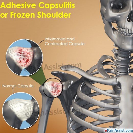 Adhesive Capsulitis: Treatment, Causes, Symptoms, Types