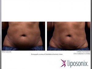 Liposonix Before & After Photos | MBody Modern Body Contouring & Laser Center Northern Virginia