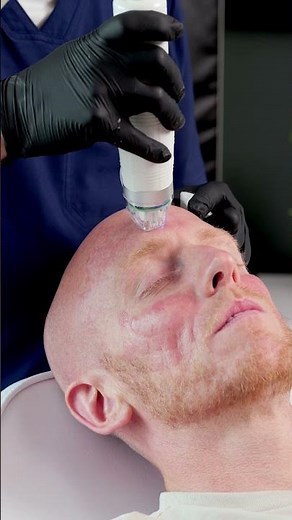Derma RF