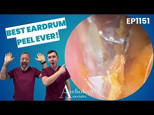 EPIC Skin Peel! Deep Ear Wax Removal with Microsuction - EP1151