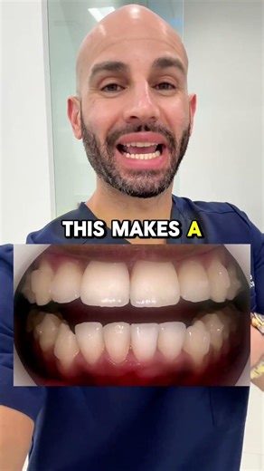 How long does Invisalign take? It depends, but this person is only 5 months in…