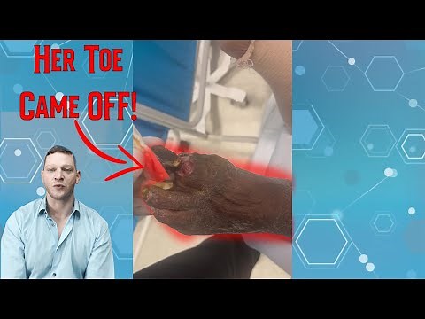 Witnessing an AutoAmputation, Gangrene causing the toe to FALL OFF | Podiatry Explained