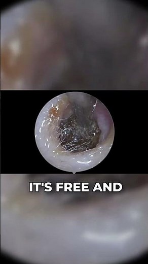 Huge Earwax Plug Stuck in the Ear Canal | Wax Off Short Episode 82
