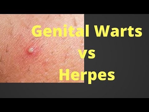 Genital Warts Vs Herpes - Herpes Vs Genital Warts - Difference Between Herpes And Genital Warts
