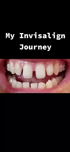 My Invisalign Journey: Overcoming Pain for a Perfect Smile