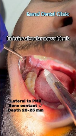 Painless IANB Administration 😌 #dentist #painfree #painfreedentistry