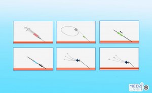 Tecnica di Seldinger: l'uso del filo-guida per le procedure - Med4Care