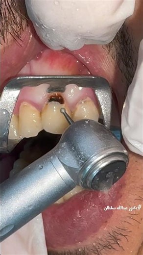 Removal Careis Of Upper Canine class V #dr_abdullah_sultan_dentist